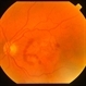 Wet AMD